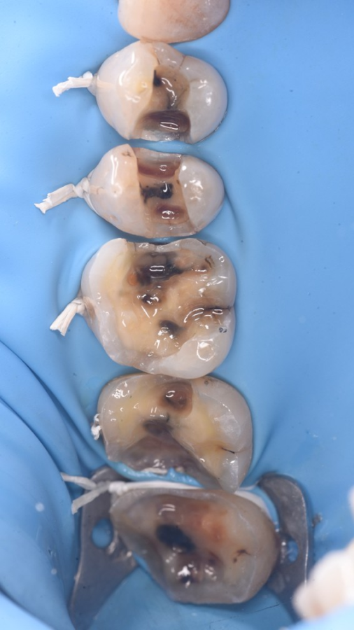 implants dentaires strasbourg orangerie implants dentaires strasbourg orangerie Remplacement d’anciens soins Dentiste Orangerie, Strasbourg | Esthétique & Implant