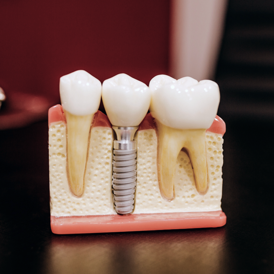 implants dentaires sur mesure Accueil Dentiste Orangerie, Strasbourg | Esthétique & Implant