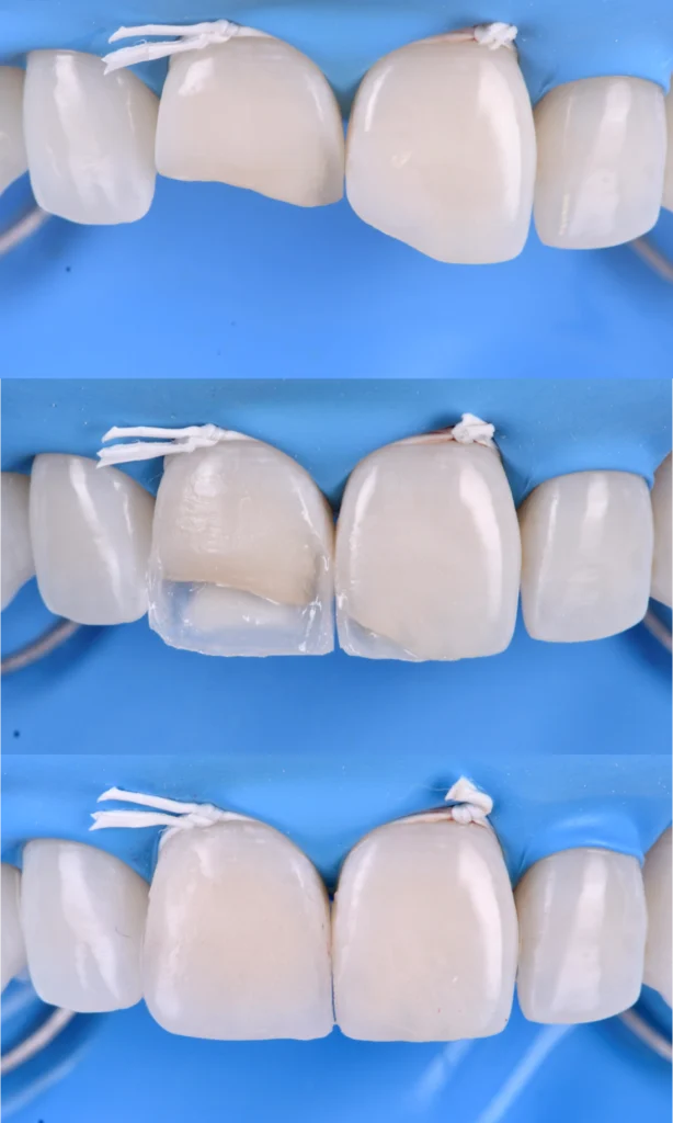 malpositions dentaires strasbourg Composite stratifié : la précision esthétique au naturel Dentiste Orangerie, Strasbourg | Esthétique & Implant