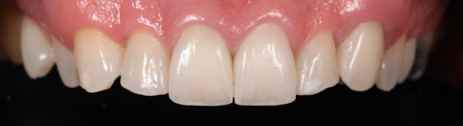 nettoyage dentaire strasbourg Couronnes dentaires : allier esthétique et durabilité Dentiste Orangerie, Strasbourg | Esthétique & Implant