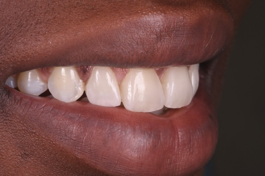 onlay inlay strasbourg Remodelage esthétique des gencives Dentiste Orangerie, Strasbourg | Esthétique & Implant
