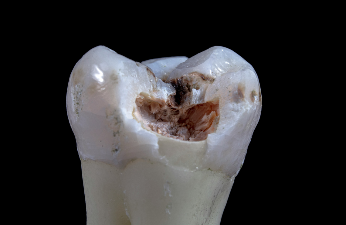 orangerie chirurgie esthetique Gestion des caries : préserver vos dents avant tout Dentiste Orangerie, Strasbourg | Esthétique & Implant