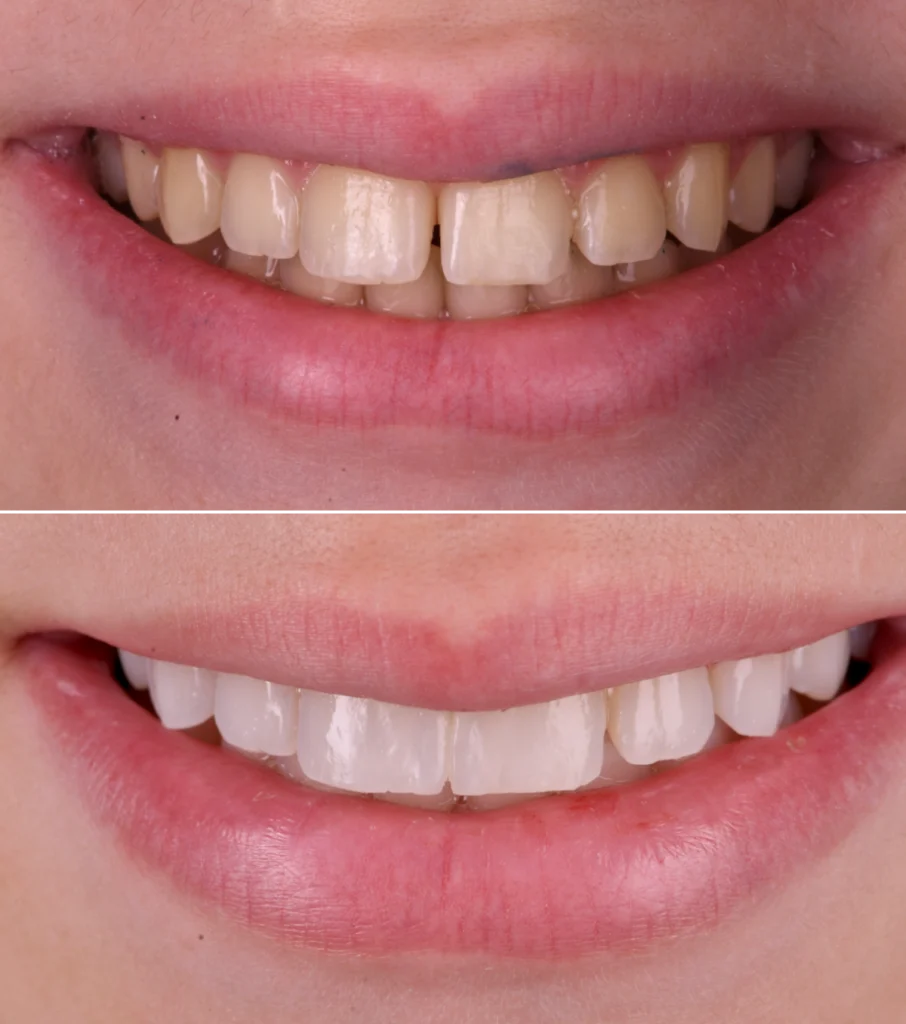 orthodontie invisible strasbourg Composite stratifié : la précision esthétique au naturel Dentiste Orangerie, Strasbourg | Esthétique & Implant
