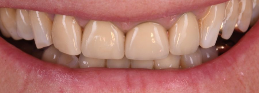 planification implants strasbourg Remodelage esthétique des gencives Dentiste Orangerie, Strasbourg | Esthétique & Implant