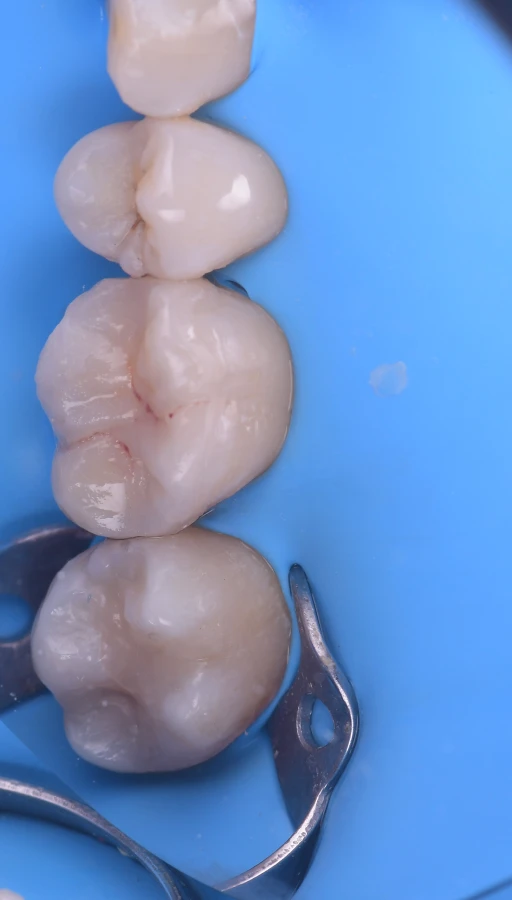 planification numerique chirurgie guidee Inlays / Onlays : préserver et restaurer vos dents Dentiste Orangerie, Strasbourg | Esthétique & Implant