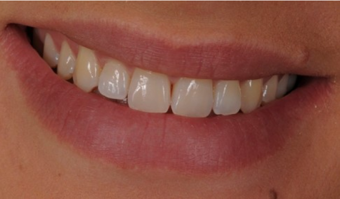 prothese fixe strasbourg Blanchiment dentaire : un sourire éclatant en toute sécurité Dentiste Orangerie, Strasbourg | Esthétique & Implant