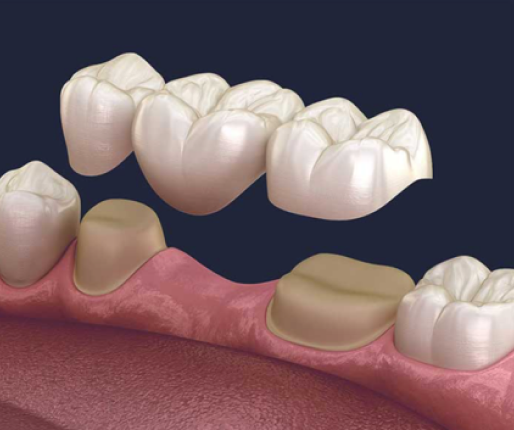 prothese sur implants strasbourg prothese sur implants strasbourg Bridges dentaires Dentiste Orangerie, Strasbourg | Esthétique & Implant