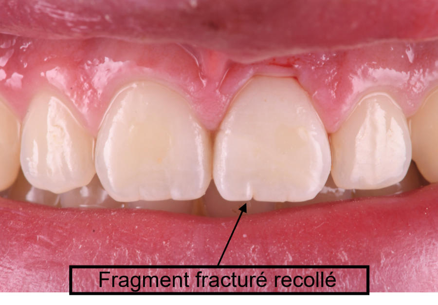 protheses dentaires strasbourg protheses dentaires strasbourg Traitement des fractures Dentiste Orangerie, Strasbourg | Esthétique & Implant