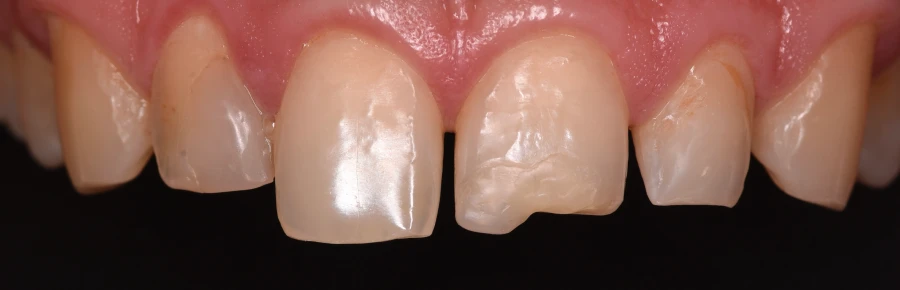 remodelage esthetique gencives Facettes dentaires : pour un sourire parfait et naturel Dentiste Orangerie, Strasbourg | Esthétique & Implant
