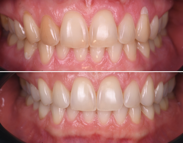 remplacement couronne abimee remplacement couronne abimee Endodontie : sauver vos dents de l’intérieur Dentiste Orangerie, Strasbourg | Esthétique & Implant