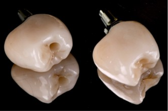 reparation dentaire strasbourg reparation dentaire strasbourg Prothèses sur implants Dentiste Orangerie, Strasbourg | Esthétique & Implant