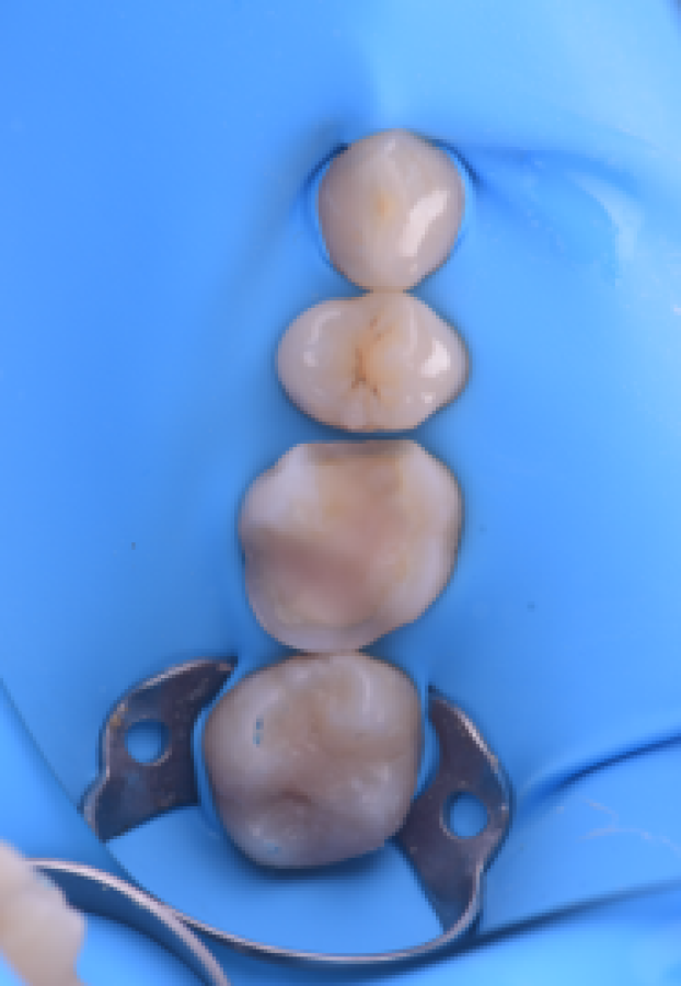 retouche sourire strasbourg Inlays / Onlays : préserver et restaurer vos dents Dentiste Orangerie, Strasbourg | Esthétique & Implant