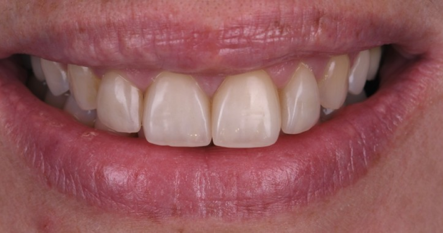 soins complets strasbourg Couronnes dentaires : allier esthétique et durabilité Dentiste Orangerie, Strasbourg | Esthétique & Implant