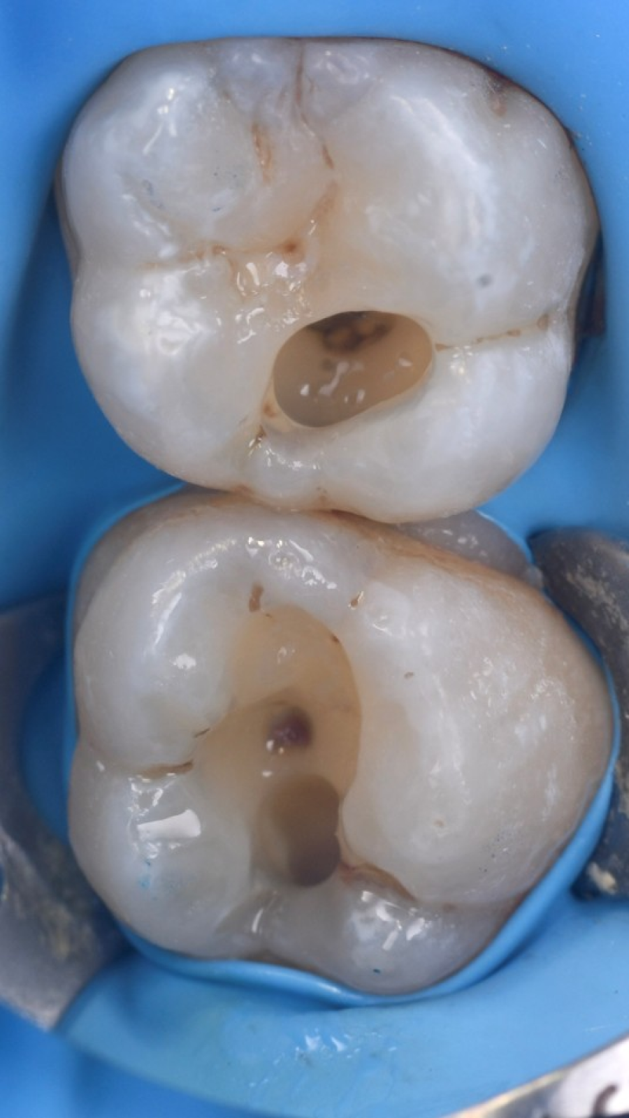 soins esthetiques strasbourg soins esthetiques strasbourg Gestion des caries : préserver vos dents avant tout Dentiste Orangerie, Strasbourg | Esthétique & Implant