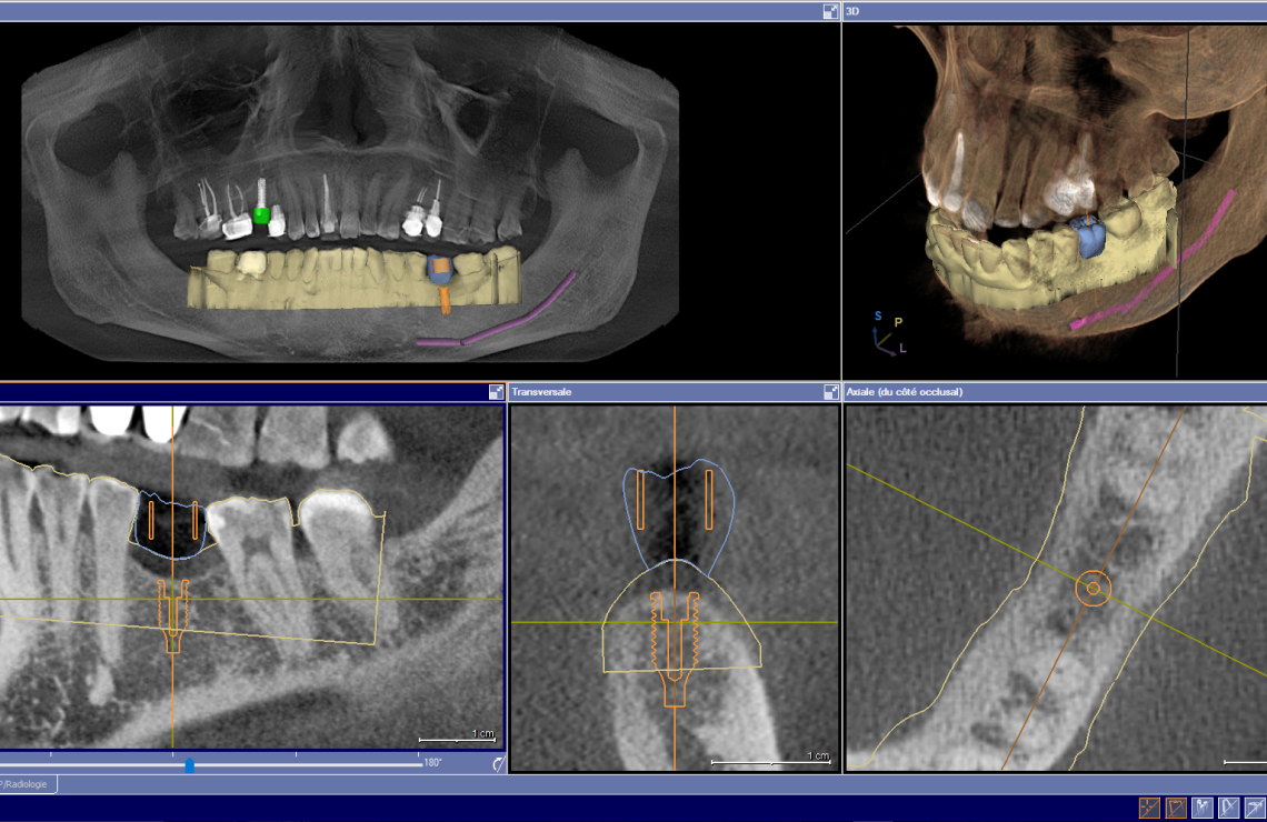 soins gencives avances Planification numérique et chirurgie guidée : précision et sécurité Dentiste Orangerie, Strasbourg | Esthétique & Implant