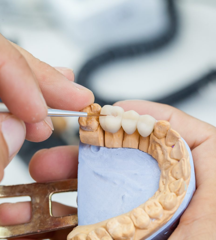 Dentiste Orangerie, Strasbourg | Esthétique & Implant image Planification numérique et chirurgie guidée : précision et sécurité Implantologie : des solutions innovantes pour restaurer votre sourire