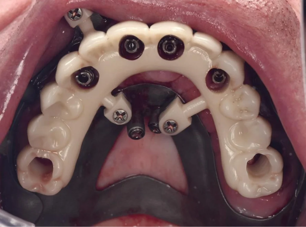 soins gencives laser Planification numérique et chirurgie guidée : précision et sécurité Dentiste Orangerie, Strasbourg | Esthétique & Implant