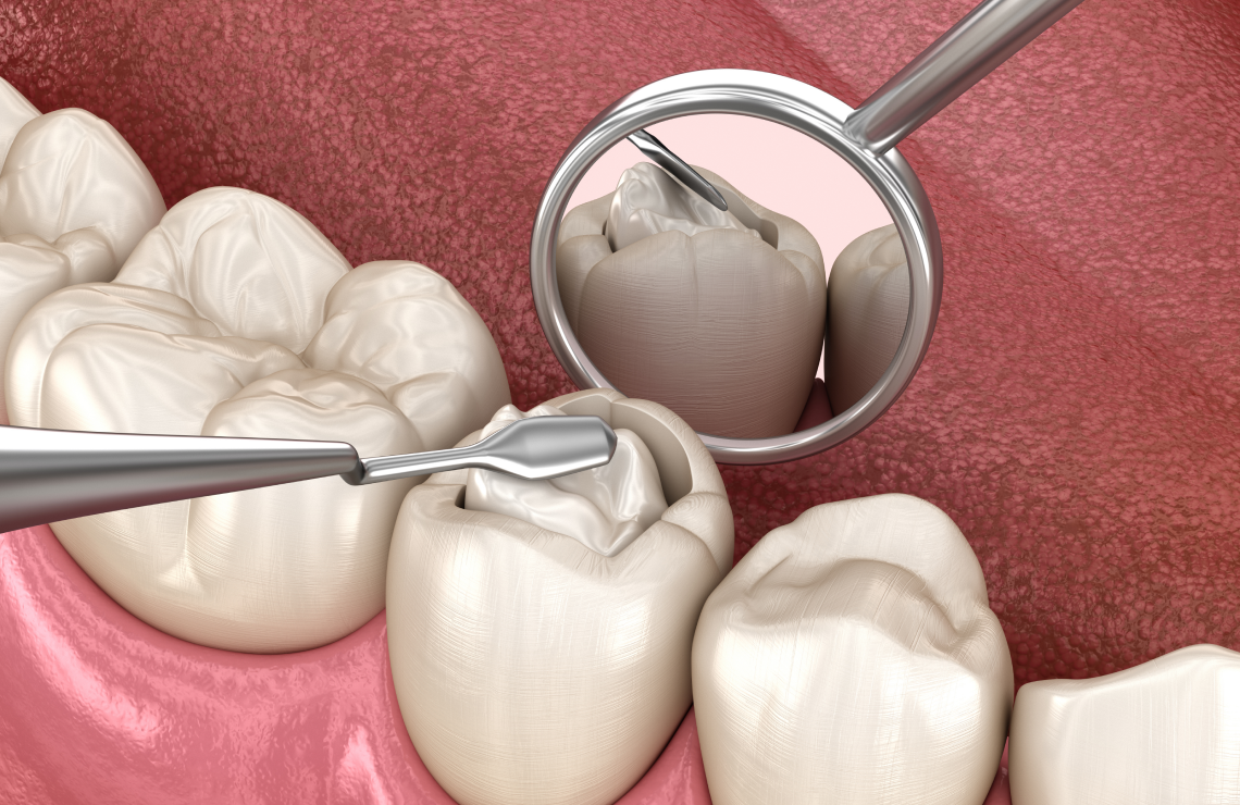 soins gencives precision Inlays / Onlays : préserver et restaurer vos dents Dentiste Orangerie, Strasbourg | Esthétique & Implant