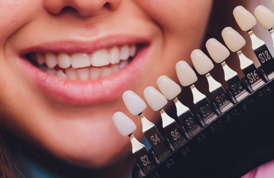 soins gencives rapides Facettes dentaires : pour un sourire parfait et naturel Dentiste Orangerie, Strasbourg | Esthétique & Implant