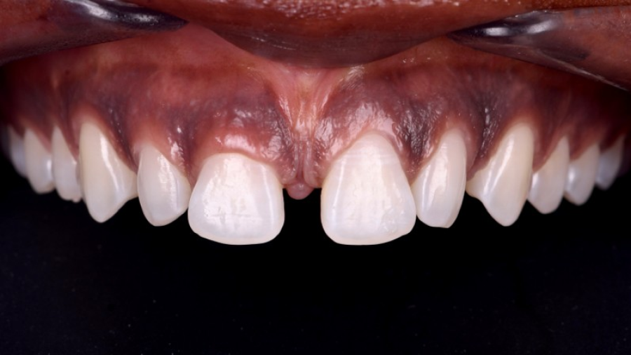 soins urgents strasbourg Remodelage esthétique des gencives Dentiste Orangerie, Strasbourg | Esthétique & Implant