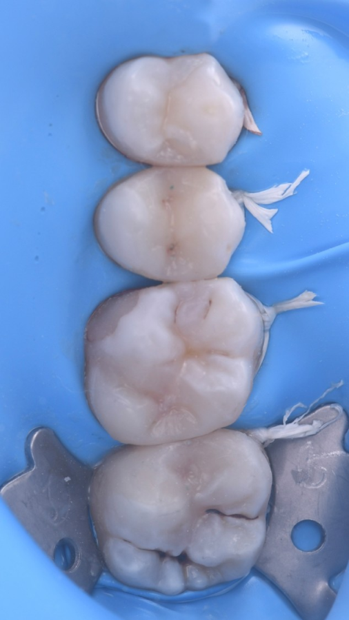 sourire eclatant strasbourg Inlays / Onlays : préserver et restaurer vos dents Dentiste Orangerie, Strasbourg | Esthétique & Implant