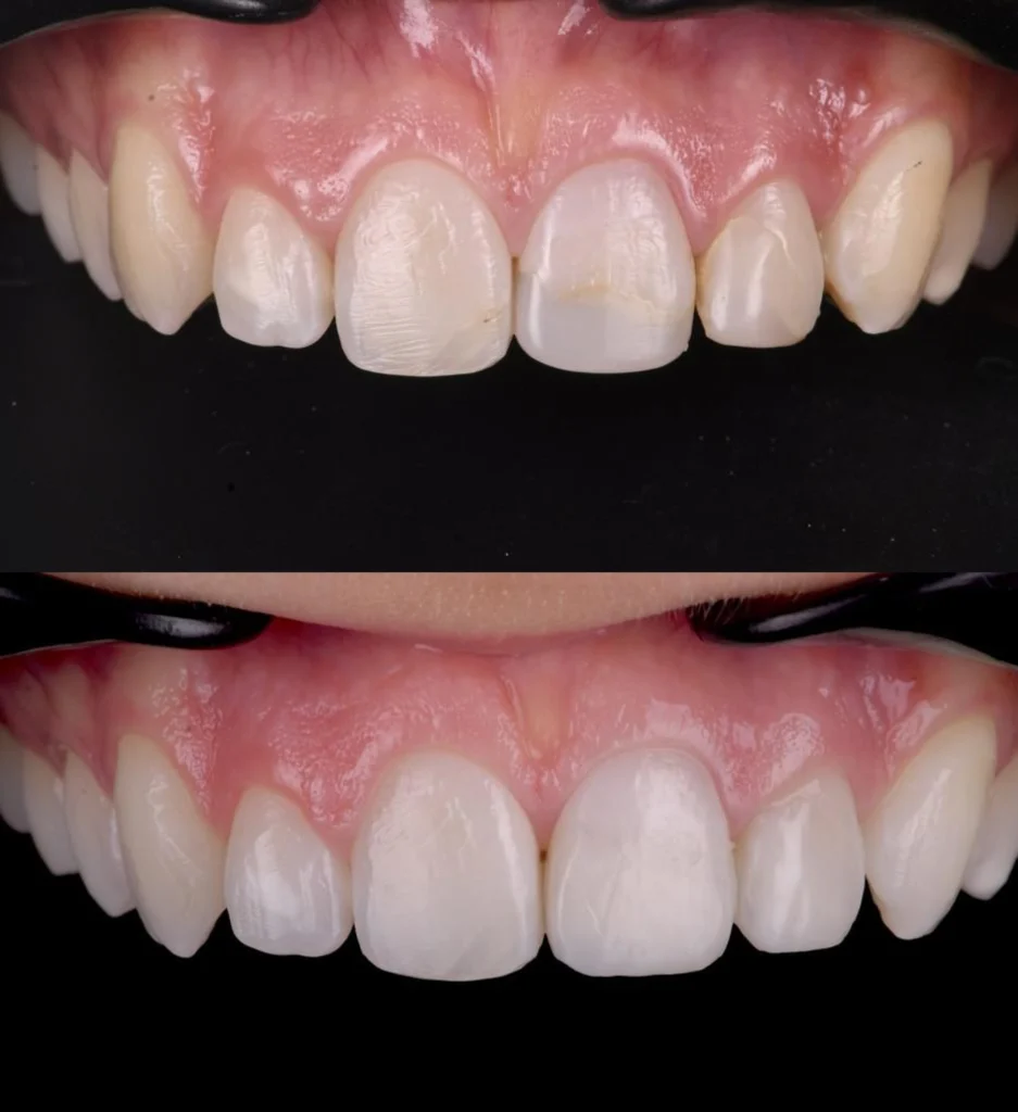 strasbourg orangerie couronnes strasbourg orangerie couronnes Remplacement d’anciens soins Dentiste Orangerie, Strasbourg | Esthétique & Implant