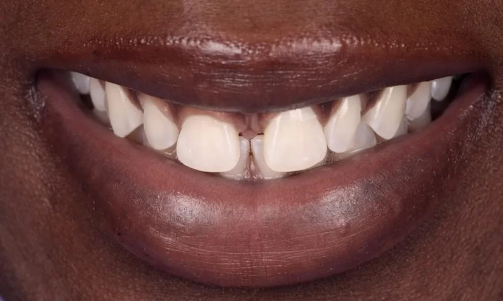 strasbourg orangerie gencives Malpositions dentaires : les diastèmes interdentaires Dentiste Orangerie, Strasbourg | Esthétique & Implant