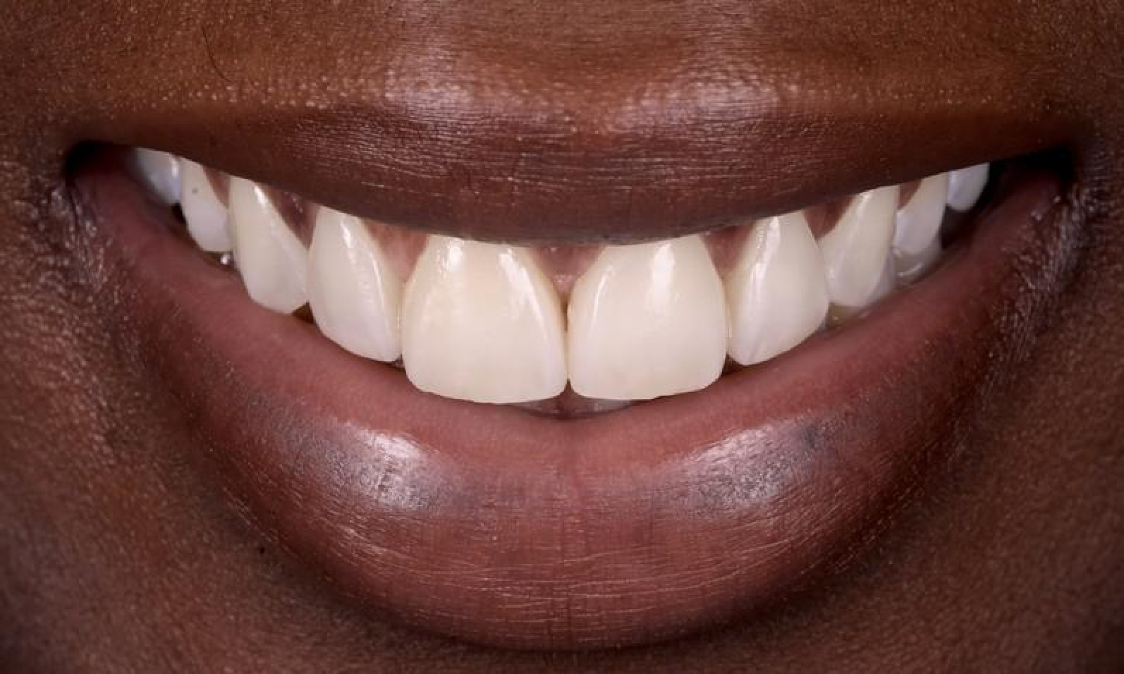 strasbourg orangerie sourire Malpositions dentaires : les diastèmes interdentaires Dentiste Orangerie, Strasbourg | Esthétique & Implant