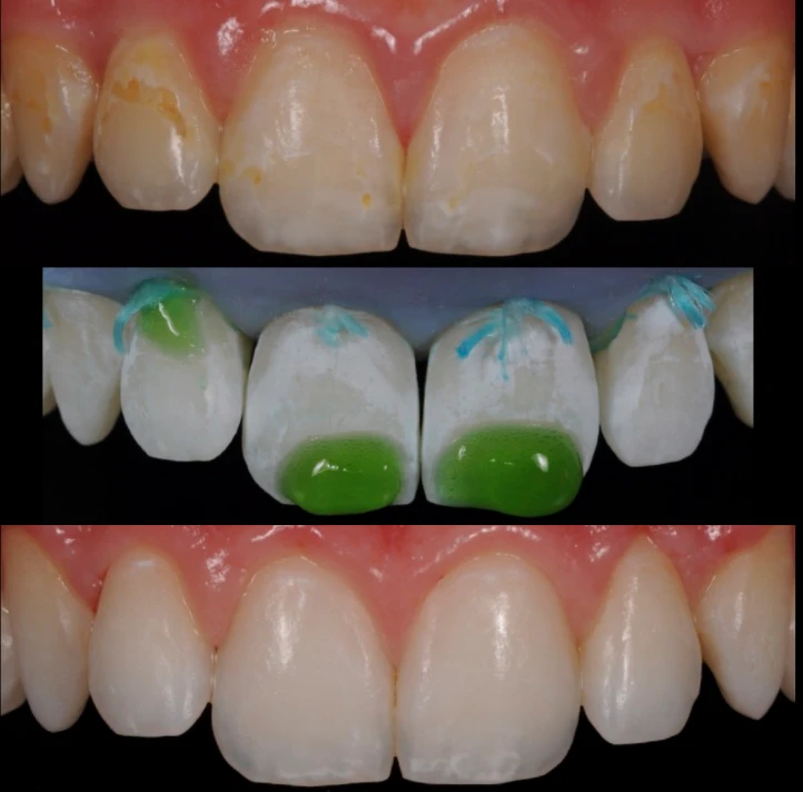 taches dentaires traitement strasbourg 1 Traitement des tâches dentaires : un sourire magnifié Dentiste Orangerie, Strasbourg | Esthétique & Implant