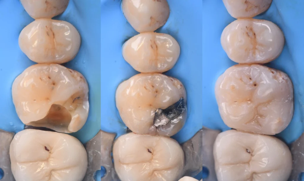 traitement blanchiment professionnel traitement blanchiment professionnel Caries, usure et érosion : préserver l’émail et la structure dentaire Dentiste Orangerie, Strasbourg | Esthétique & Implant