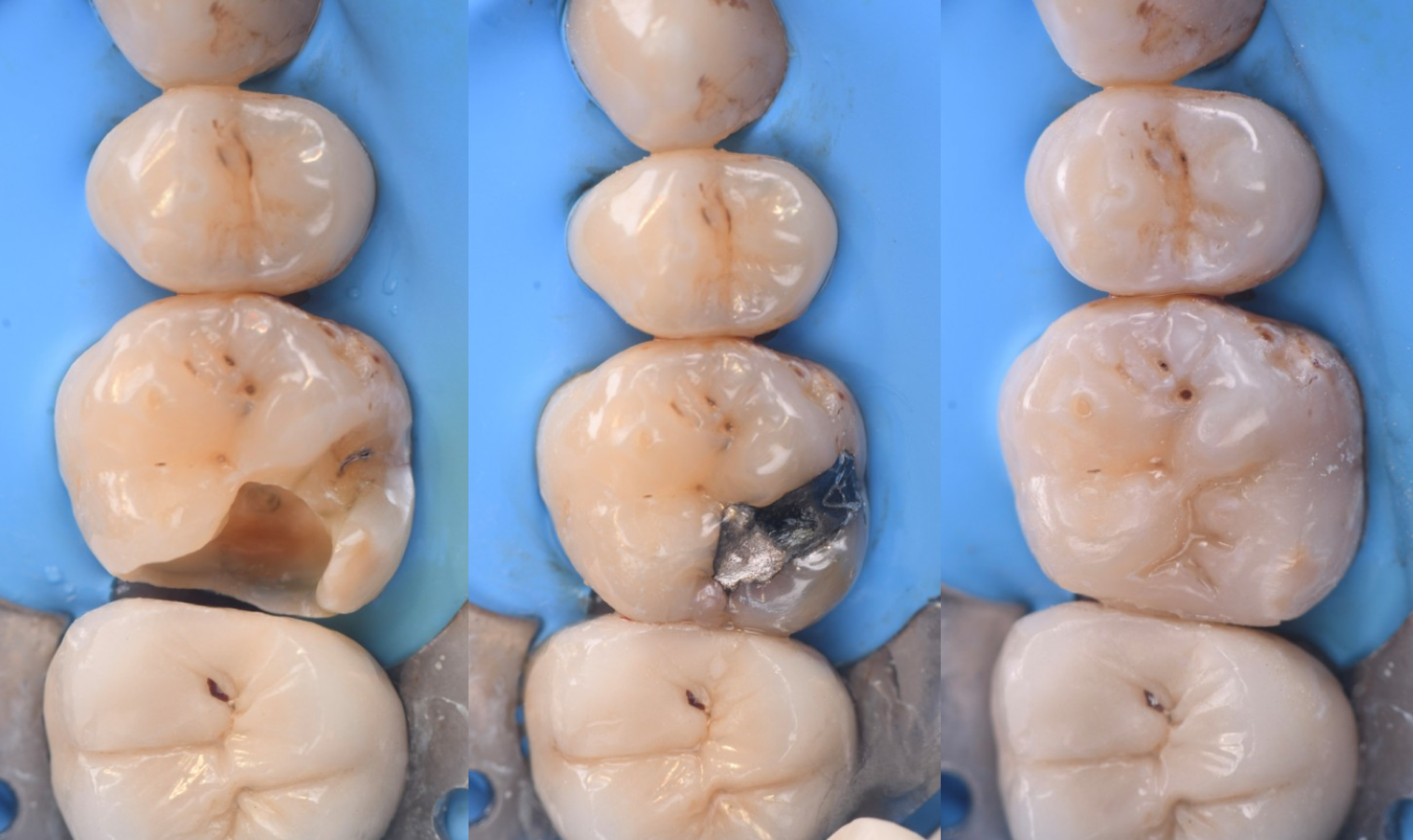 traitement blanchiment professionnel Caries, usure et érosion : préserver l’émail et la structure dentaire Dentiste Orangerie, Strasbourg | Esthétique & Implant