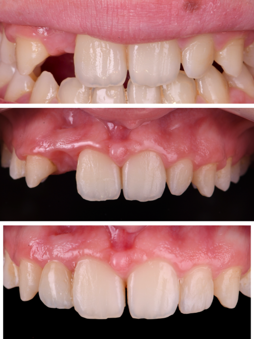 traitement caries strasbourg traitement caries strasbourg Bridges dentaires Dentiste Orangerie, Strasbourg | Esthétique & Implant
