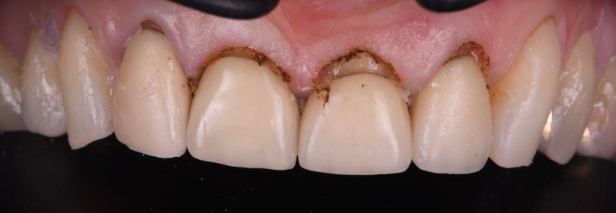 traitement composite strasbourg Remodelage esthétique des gencives Dentiste Orangerie, Strasbourg | Esthétique & Implant