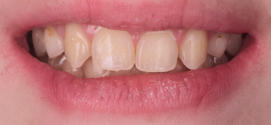 traitement gencives inflammees parodontite traitement gencives inflammees parodontite Agénésies dentaires : remplacer une dent absente dès la naissance Dentiste Orangerie, Strasbourg | Esthétique & Implant