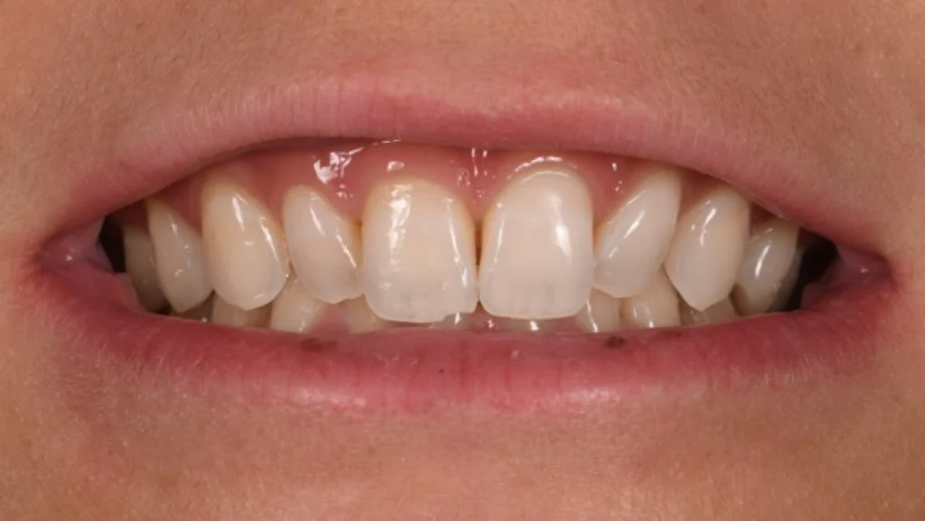 traitement gencives orangerie traitement gencives orangerie Concept de gradient thérapeutique Dentiste Orangerie, Strasbourg | Esthétique & Implant