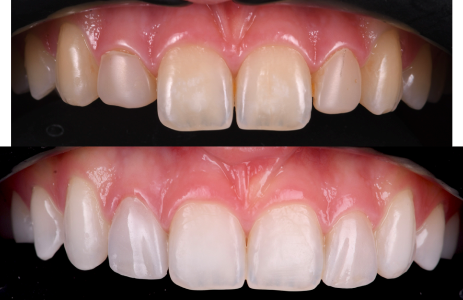 traitement gencives strasbourg Facettes dentaires : pour un sourire parfait et naturel Dentiste Orangerie, Strasbourg | Esthétique & Implant
