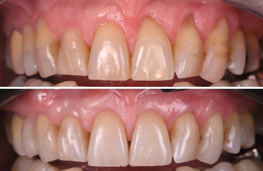 traitement occlusion strasbourg Greffes de gencives et chirurgie mucogingivale Dentiste Orangerie, Strasbourg | Esthétique & Implant