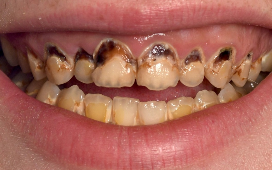 traitement parodontal strasbourg traitement parodontal strasbourg Gestion des caries : préserver vos dents avant tout Dentiste Orangerie, Strasbourg | Esthétique & Implant