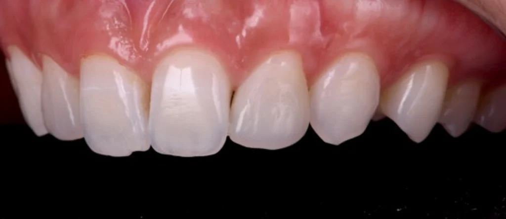 traitement parodontite strasbourg traitement parodontite strasbourg Concept de gradient thérapeutique Dentiste Orangerie, Strasbourg | Esthétique & Implant