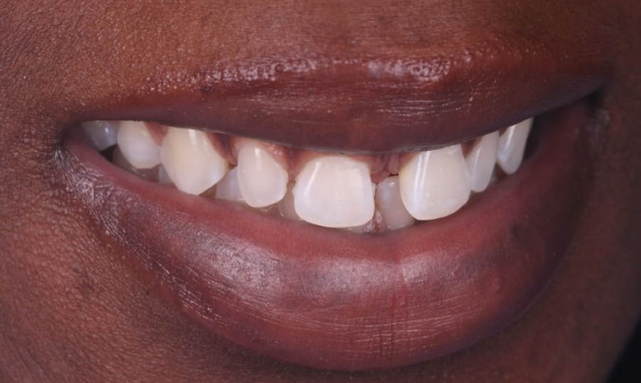 traitement racine strasbourg Remodelage esthétique des gencives Dentiste Orangerie, Strasbourg | Esthétique & Implant