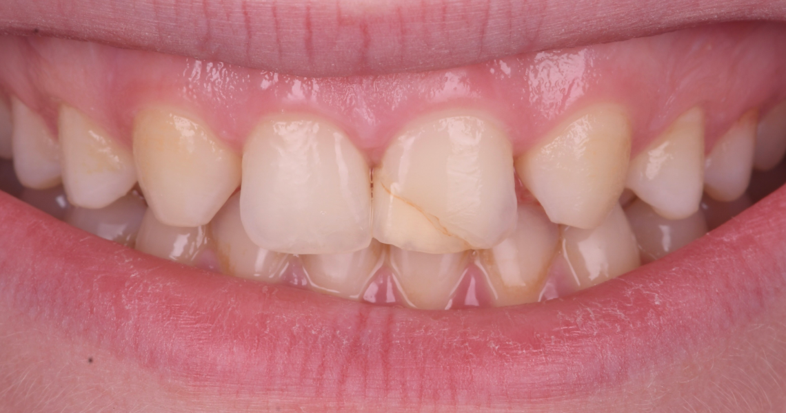 Dentiste Orangerie, Strasbourg | Esthétique & Implant taches dentaires traitement strasbourg Traitement des tâches dentaires : un sourire magnifié Dentisterie esthétique : sublimez votre sourire