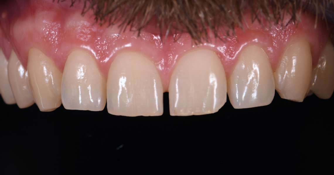 Dentiste Orangerie, Strasbourg | Esthétique & Implant soins gingivaux strasbourg Concept de gradient thérapeutique Dentisterie esthétique : sublimez votre sourire