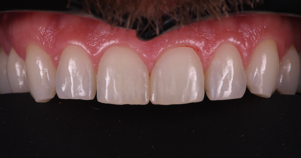Dentiste Orangerie, Strasbourg | Esthétique & Implant soins gingivaux strasbourg Concept de gradient thérapeutique Dentisterie esthétique : sublimez votre sourire