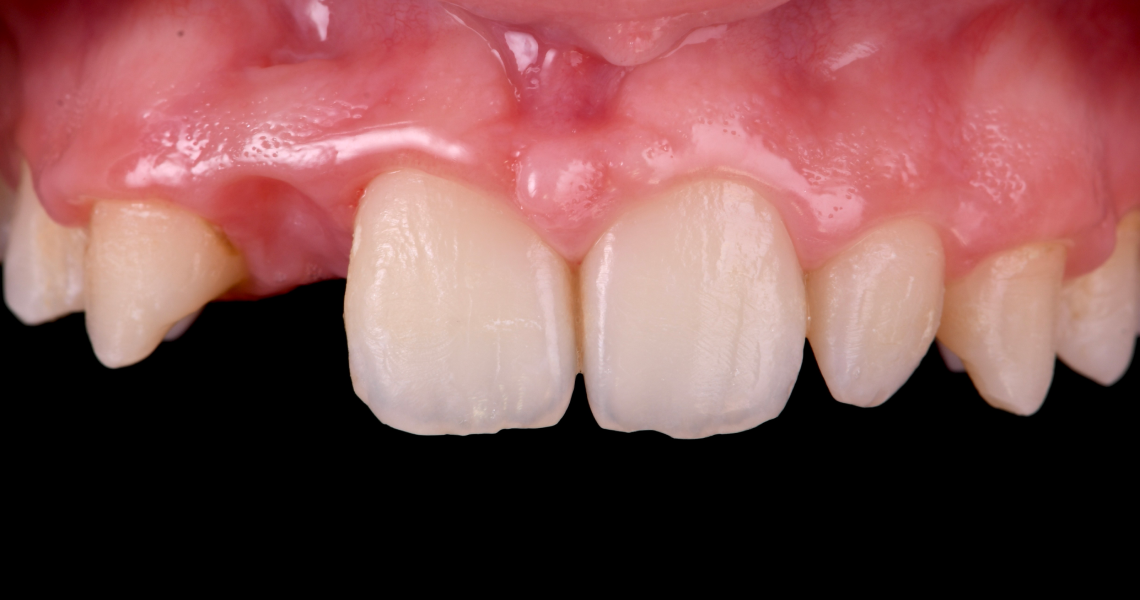 Dentiste Orangerie, Strasbourg | Esthétique & Implant taches dentaires traitement strasbourg Traitement des tâches dentaires : un sourire magnifié Dentisterie esthétique : sublimez votre sourire