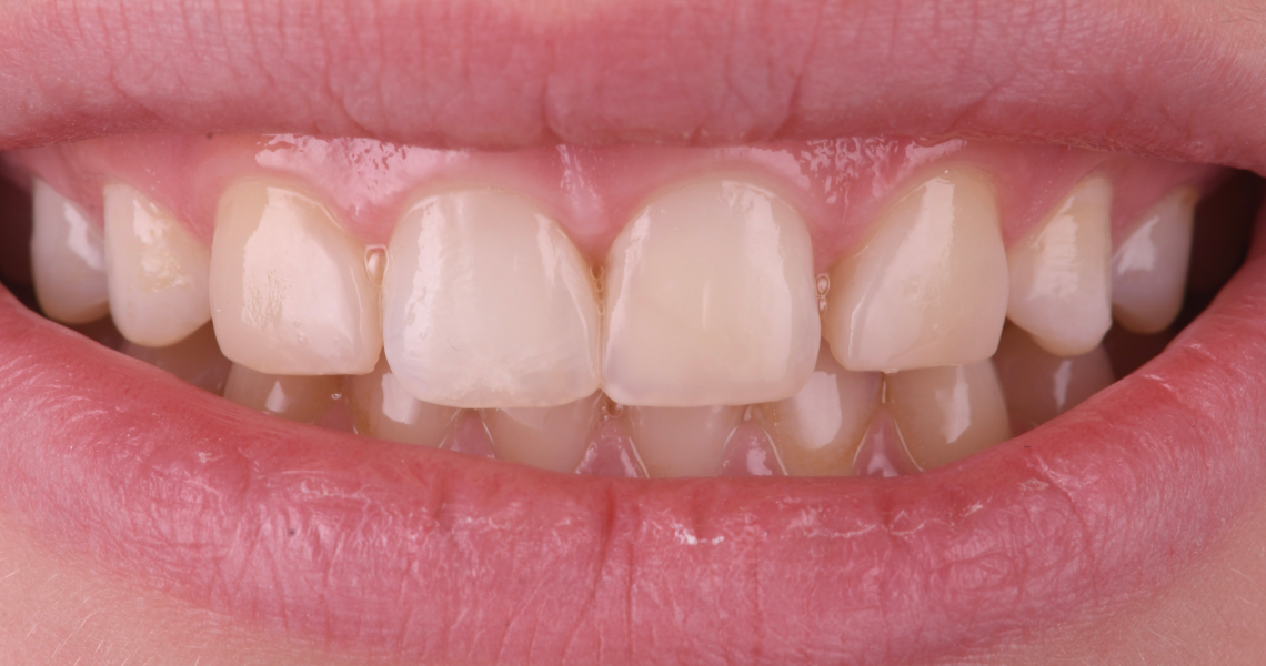Dentiste Orangerie, Strasbourg | Esthétique & Implant taches dentaires traitement strasbourg Traitement des tâches dentaires : un sourire magnifié Dentisterie esthétique : sublimez votre sourire