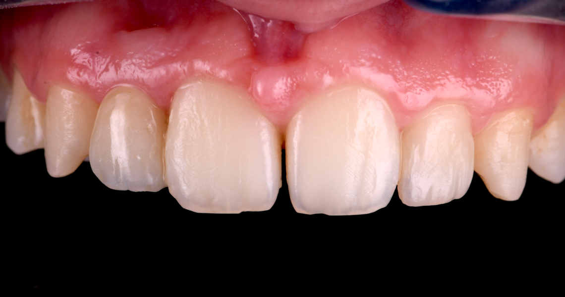 Dentiste Orangerie, Strasbourg | Esthétique & Implant taches dentaires traitement strasbourg Traitement des tâches dentaires : un sourire magnifié Dentisterie esthétique : sublimez votre sourire
