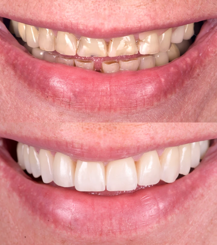 composite stratifie precision esthetique composite stratifie precision esthetique Des traitements esthétiques pour transformer votre sourire Dentiste Orangerie, Strasbourg | Esthétique & Implant
