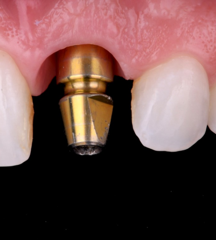 Dentiste Orangerie, Strasbourg | Esthétique & Implant d Bruxisme : une usure dentaire silencieuse et destructrice Quand consulter