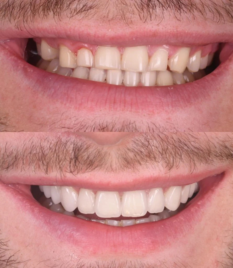 facettes blanchiment strasbourg facettes blanchiment strasbourg Des traitements esthétiques pour transformer votre sourire Dentiste Orangerie, Strasbourg | Esthétique & Implant
