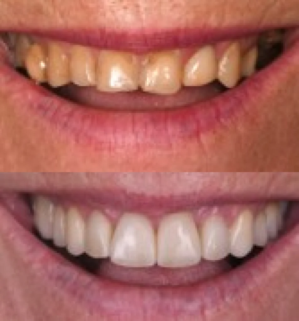facettes ceramique orangerie facettes ceramique orangerie Des traitements esthétiques pour transformer votre sourire Dentiste Orangerie, Strasbourg | Esthétique & Implant